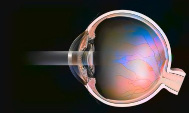 Sectional eye with secondary cataract treated with YAG laser.