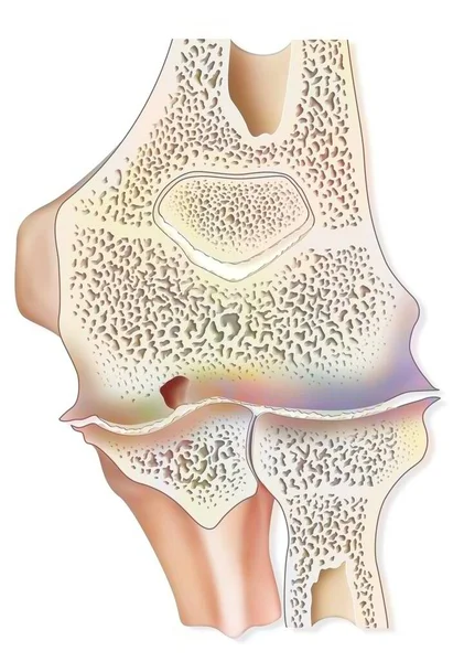 Hemophilic Arthropathy Elbow Hemarthrosis Sagittal Section — 스톡 사진