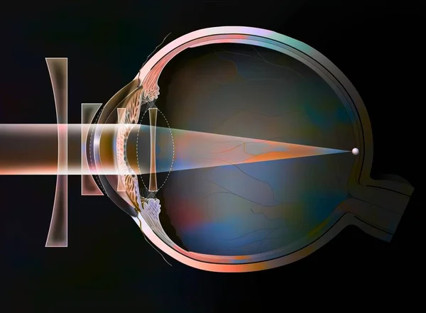 Different Possible Corrections Myopic Eye Spectacle Lenses External Lenses — Foto Stock