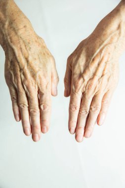 Hands with spots of old age