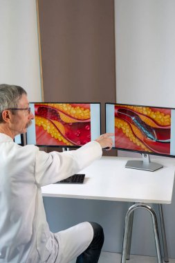A doctor showing atheroma plaque and stent placement images on computer screens.