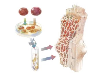 Transplant of hematopoietic stem cells administered to colonize the bone marrow.