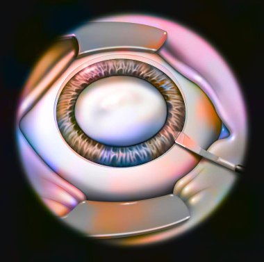 Eye, cataract, phacoemulsification - step 1: making the self-sealing incision.