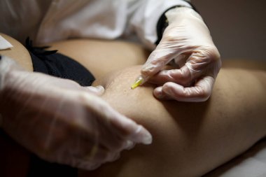 Treatment of cellulite and stretch marks by carboxytherapy, or the subcutaneous injection of carbon dioxide.