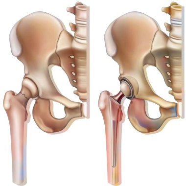 Femoral neck fracture (osteoporosis) and hip prosthesis.