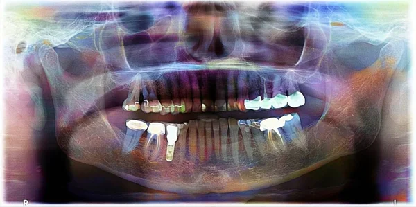 Dental panoramic of a 72 year old person with an implant and crowns.