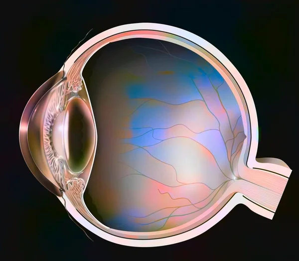 Eye Clouding Lens Case Anterior Subcapsular Cataract — Foto Stock