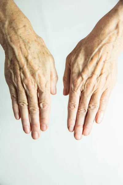 Hands Spots Old Age — Stockfoto