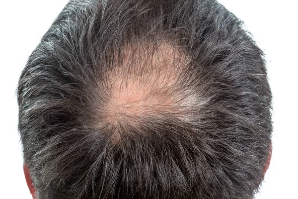 Baldness. close-up of bald man