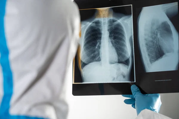 Doctor Covid Ward Hospital Examining Rays Lungs — Foto de Stock