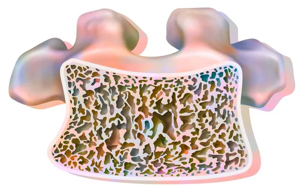 Dorsal Vertebrae Osteoporosis Partially Destroyed Cancellous Tissue — Stock Photo, Image