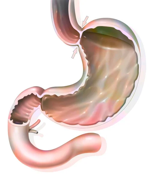 Stomach Normal Hermetic Gastroesophageal Sphincter Preventing Gastroesophageal Reflux — Stock Photo, Image