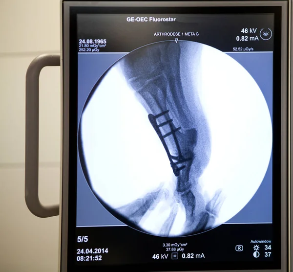 Report Orthopedic Surgery Department Lman Hospitals Thonon Operating Room Ray — Stockfoto