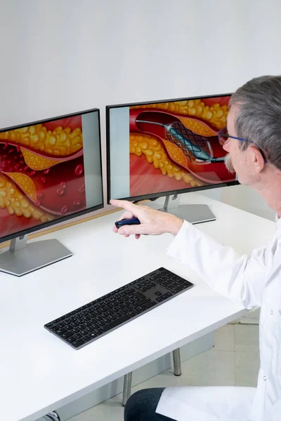 Doctor Showing Atheroma Plaque Stent Placement Images Computer Screens — 图库照片