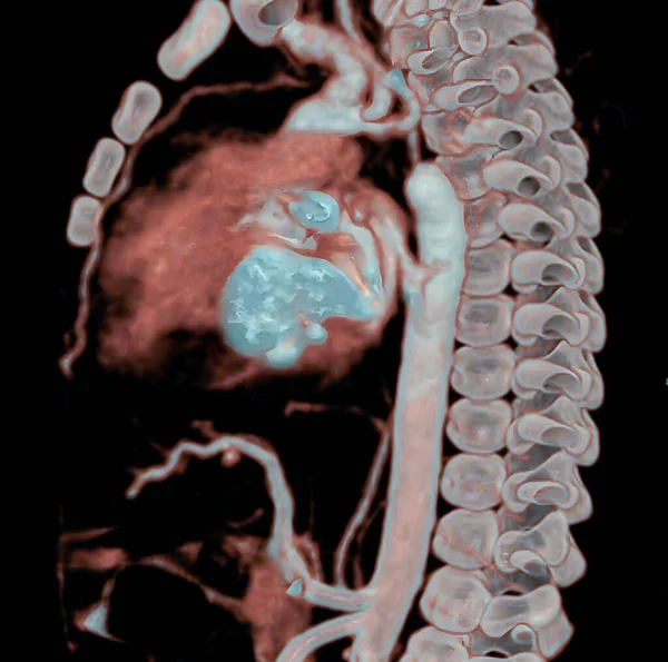 Aortic Coarctation Newborn Surgery Aortic Coarctation Narrowing Aorta Often Considerable — Stok fotoğraf