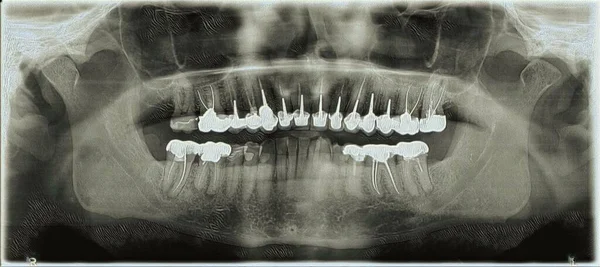 Dental Panoramic Year Old Person Multiple Crowns — Stock fotografie