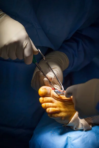 Orthopedic Surgery Operating Room Arthrodesis Big Toe — Fotografia de Stock