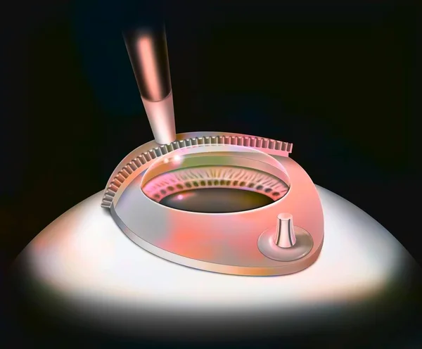 Eye Surgery Lasik Step Microrobot Guided Suction Ring — Zdjęcie stockowe