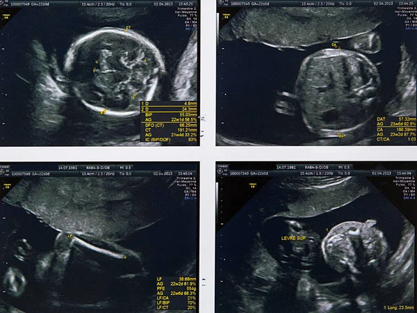 2Nd Trimester Ultrasound Fetus — Photo