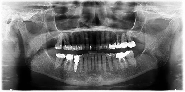 Dental Panoramic Year Old Person Implant Crowns — Foto Stock