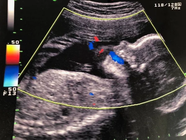 Ultrasound Fetus Profile Head Expiring Amniotic Fluid His Mouth Regular — Photo