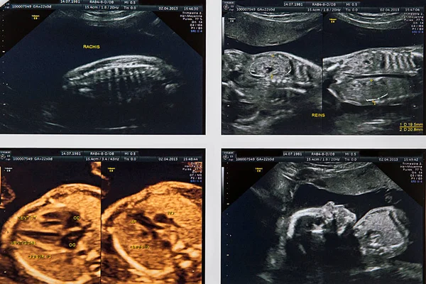 2Nd Trimester Ultrasound Fetus — Stock Photo, Image