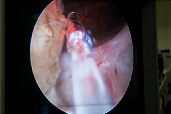 Laser Surgery Treatment Benign Prostatic Hyperplasia Endoscopic Image — Photo