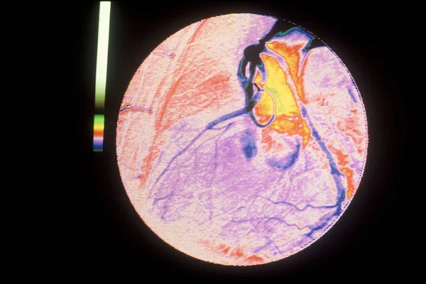 Aorta Coronary Bypass Acb Viewed Angiography — Stok fotoğraf
