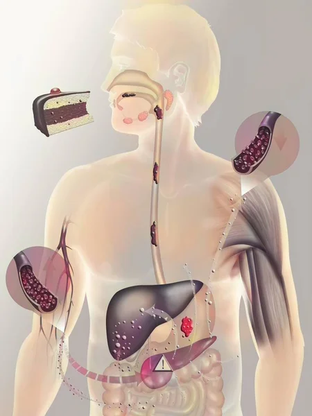 Secretion Insulin Person Diabetes Type Diabetes Type Non Insulin Dependent — 图库照片