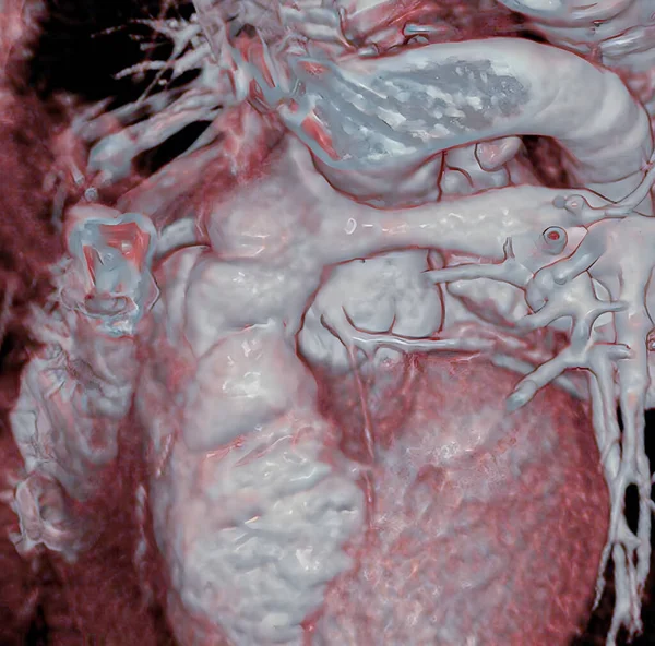 Arterial Switch Operation Aso Aorta Pulmonary Artery Cut Reconnected Correct — Stockfoto