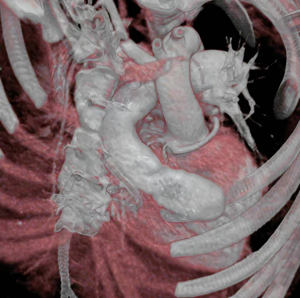 Complex Congenital Cardiopathy Scan Allows Three Dimensional Visualization Heart Surgery —  Fotos de Stock