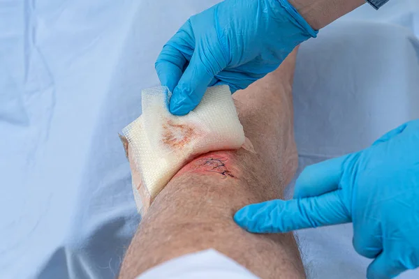 Fresh Blooded Injury Wound Tibial Bone Leg Sticking Stitches Hold — Stock Photo, Image