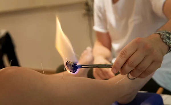 Therapist Specializing Traditional Chinese Medicine Practicing Acupuncture Moxibustion — Stockfoto