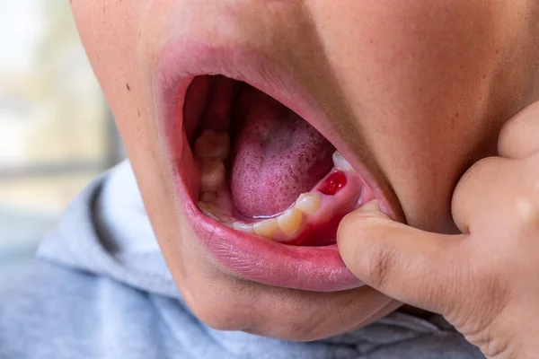 Child Opening His Mouth Fallen Tooth — Fotografia de Stock