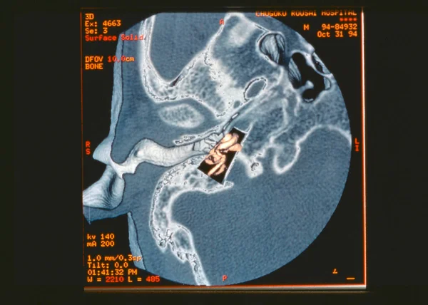 Eardrum Scanner Result Close View — Foto Stock