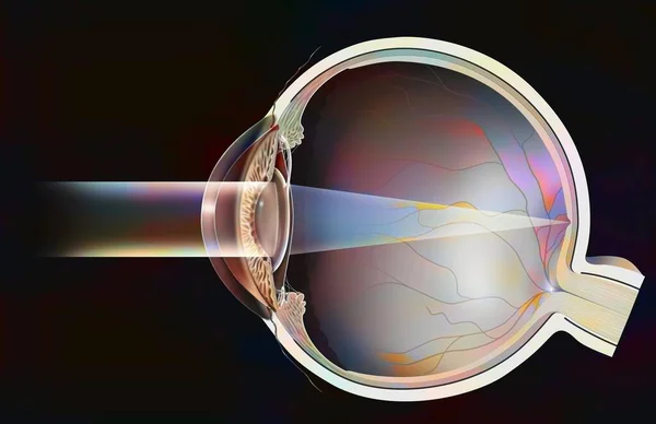 Eye Surgery Intraocular Implant Correct Cataracts — Foto Stock