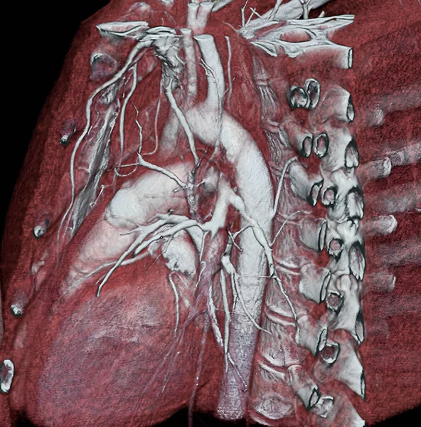 Stenosis Pulmonary Arteries Scan Shows Few Pulmonary Arteries Some Occluded —  Fotos de Stock