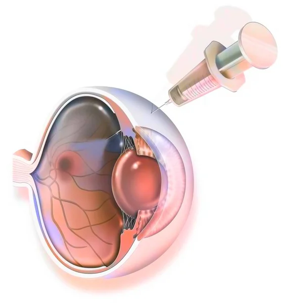Eye Treatment Macular Degeneration Rna Interference — Fotografia de Stock