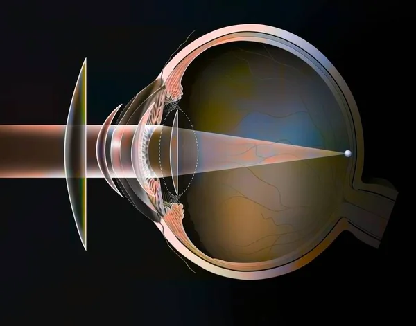Different Possible Corrections Hyperopic Eye Spectacle Lenses External Lenses — Foto Stock