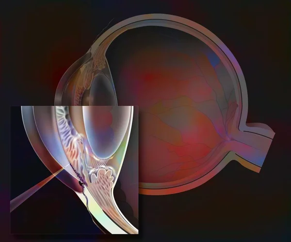 Glaucoma Glaucomatous Eye Zoom Operation Trabeculoplasty — Foto Stock