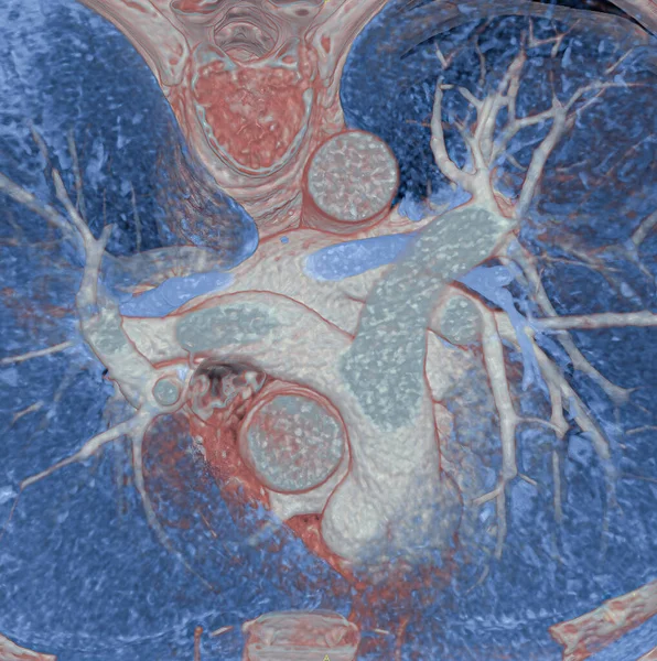 Scan Thorax Lungs Aorta Pulmonary Arteries Visible — Stok fotoğraf