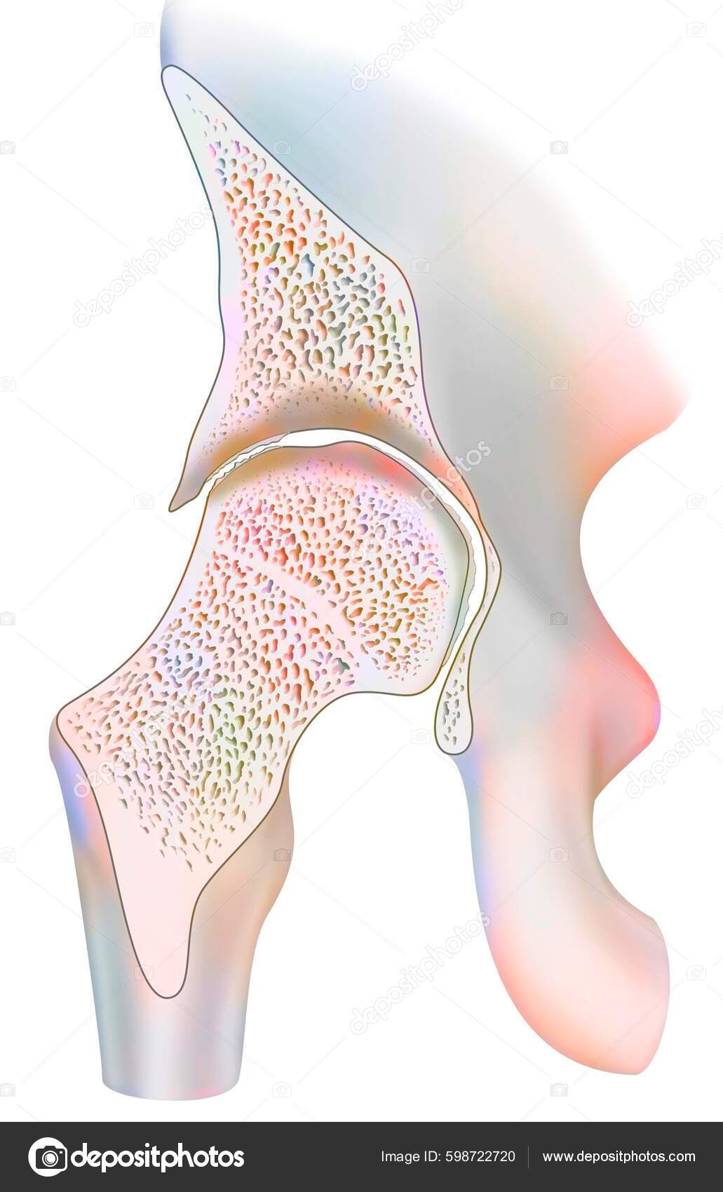 Ankle Affected Hemophilic Arthropathy Frontal Cut Stock Illustration by