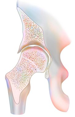 Ankle affected by hemophilic arthropathy in frontal cut.