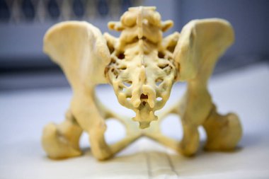 3D reconstruction from patient images, 3D printed pelvis.