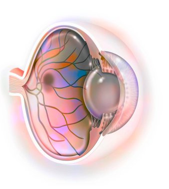 Age-related macular degeneration affecting the macula, the central area of the retina.