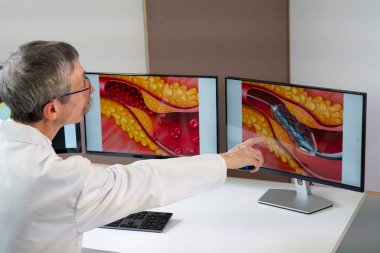 A doctor showing atheroma plaque and stent placement images on computer screens.