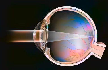 Eye surgery: intraocular implant to correct cataracts.