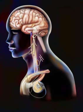 Treatment of epilepsy by stimulation of the vagus nerve with a neurostimulator box.