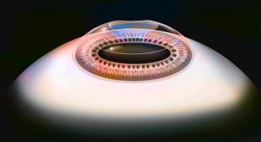 Eye, surgery, Lasik step 5: the corneal flap replaced.