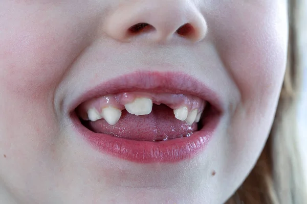 Close-up of a baby girl\'s teeth following the loss of a baby tooth